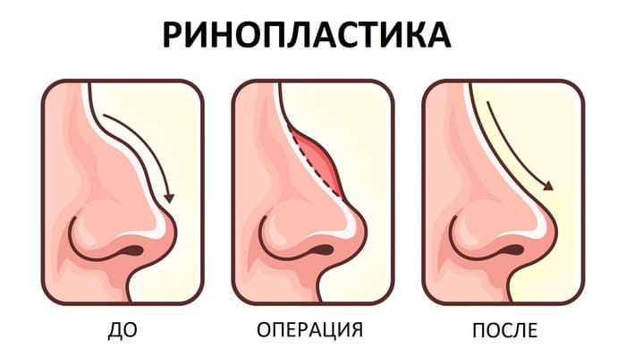 Операция на нос