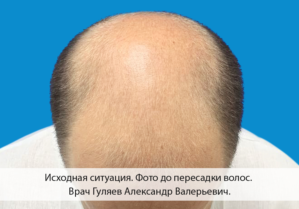 Центр пересадки волос